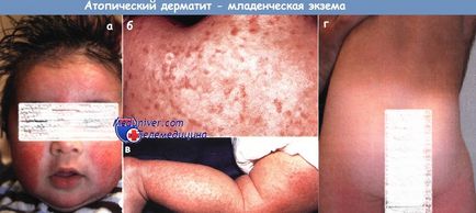 Dermatita atopica la un copil - cauze, criterii de diagnostic