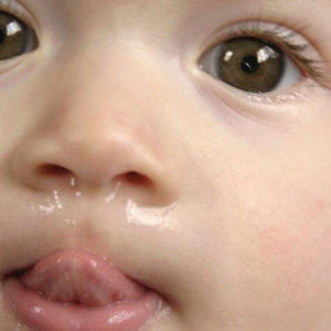 Cum să tratăm un nas curbat la un copil de 6 luni decât să tratăm