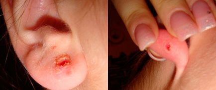 Ce trebuie să faceți dacă urechea dispare după perforare decât să se ocupe și să se îngrijească