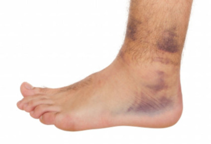 Ce trebuie să faceți cu un prejudiciu picior înainte de sosirea unui medic