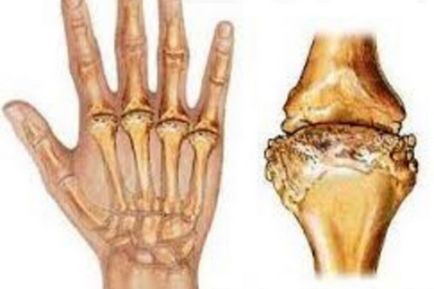 Deformáló arthrosis - a kérdés a kezelés