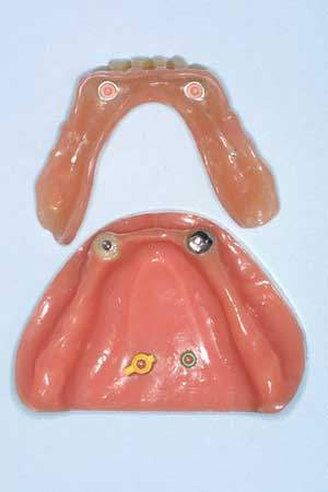 Dental-revue, статті, ортопедична, результати протезування знімними протезами з використанням