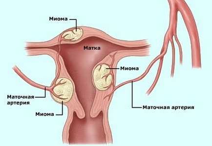 Tratamentul eficient al uterului cu remedii folclorice