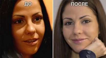 Elena Berkova a făcut o altă operație plastică
