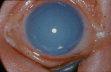 Nevoid amentia (betegség) betegség (Angioma Pia) Nevoid amentia (betegség) betegség