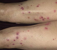 Phlebotoderma - cauze, simptome, diagnostic și tratament