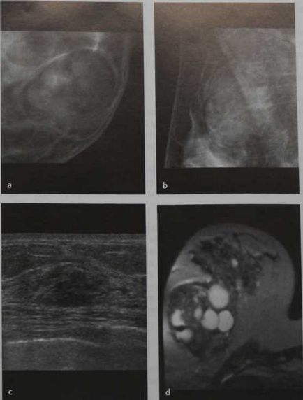 Hammaromul glandei mamare - fibroadenolipom