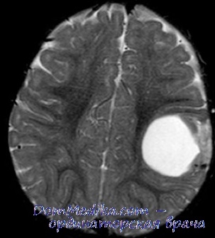 Gangliogliomul la un copil provoacă, diagnostic, tratament