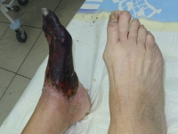 Picioarele gangrene - semne, cauze, întrebări, tratament fără amputare
