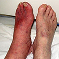 Гангрена ноги - ознаки, причини, питання, лікування без ампутації