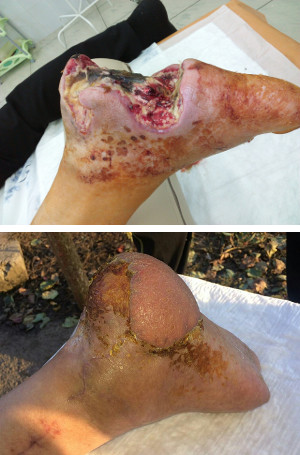 Picioarele gangrene - semne, cauze, întrebări, tratament fără amputare