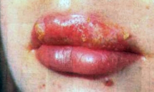 Herpes zoster este contagios sau nu - o caracteristică a problemei