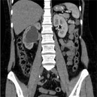 Hydronephrosis, Városi Kórház № 40