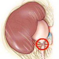 Hydronephrosis, Városi Kórház № 40