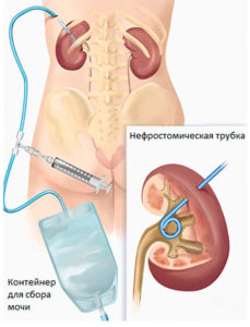 Hydronefrosisul rinichiului - simptome și tratamentul hidronefrozei la copii și adulți în străinătate, prețuri și recenzii