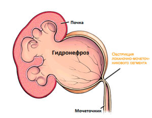 Гідронефроз нирки - симптоми і лікування гідронефрозу у дітей і дорослих за кордоном, ціни і відгуки