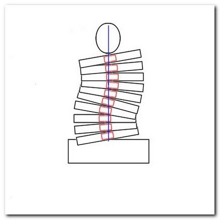 Az egyéni gyakorlatsor a scoliosis (gerincferdülés) Az egyéni gyakorlatsor a scoliosis