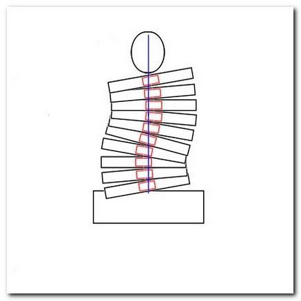 Az egyéni gyakorlatsor a scoliosis