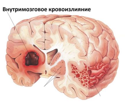 Accident vascular cerebral ischemic al creierului