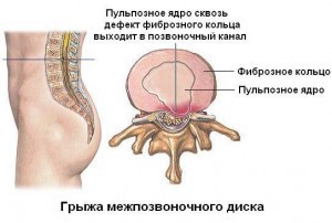 Як робити ЛФК при грижі хребта поперекового, шийного та інших відділів