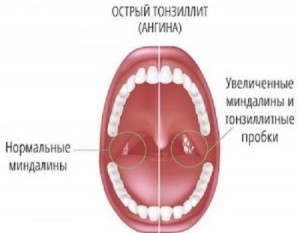 Як лікувати гнійники в горлі аптечними і народними засобами у дитини і дорослих з фото