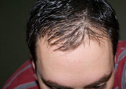 Як врятувати випадіння волосся медичний вісник