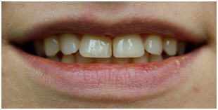 Як прибрати «щілину» між зубами без брекетів! статті