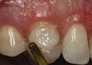 Як прибрати «щілину» між зубами без брекетів! статті