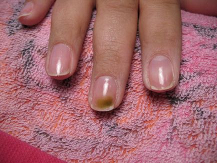 Cum de a restabili unghiile după consolidarea clădirii la domiciliu, tratamentul pentru mucegai și