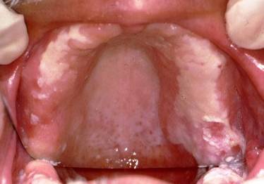 Candidiasis secol