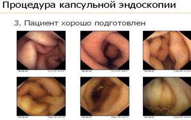 Capsule endoscopie, Spitalul Clinic Regional Chelyabinsk
