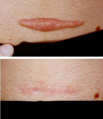 Tratamentul cicatricelor cicatrice, îndepărtarea, unguent, resurfacing cu laser, cauza