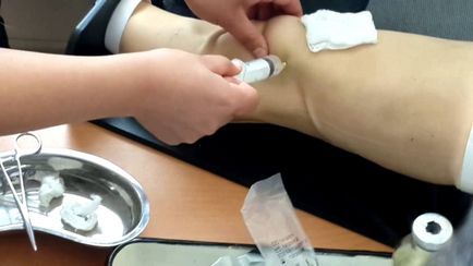 Chistul meniscului articulației genunchiului - tipuri, simptome, tratament