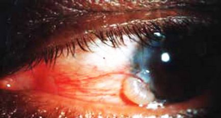 Chistul pe ochi (foto) cauze, simptome, diagnostic și tratament