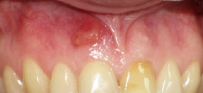 Cyst dinte, costul de a elimina chisturi de către laser, ceea ce este un chist pe dinte, simptome, tratament foto,