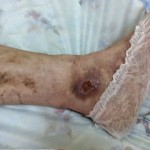 Atunci când este necesară intervenția chirurgicală - stadiile venelor varicoase, blogul unui flebolog