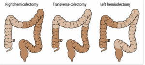 Colectomia este totală, subtotală, deschisă