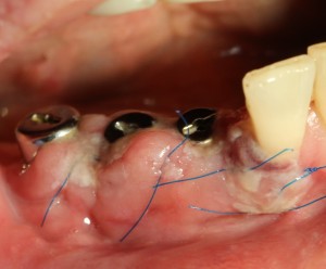 Koronák implantátumokra és képek