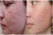Refacerea facială cu laser de la cicatrici, pete pigmentare, acnee