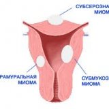 Tratamentul fibromilor uterului cu remedii folclorice - bisturiu - medical