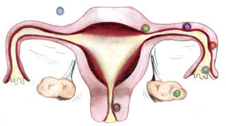 Tratamentul metritei - inflamația stratului muscular al uterului