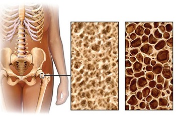 Tratamentul osteoporozei cu remedii folclorice