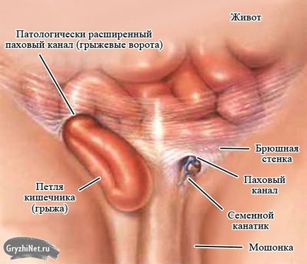 Kezelése lágyéksérv műtét nélkül férfiak és sebészeti