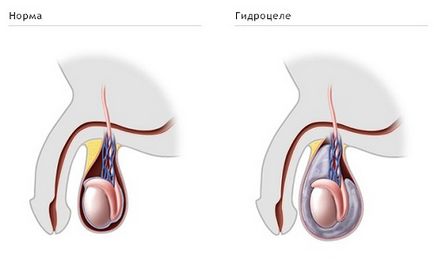 A kezelés a here ödéma és a betegség kifejlődését megelőző intézkedések