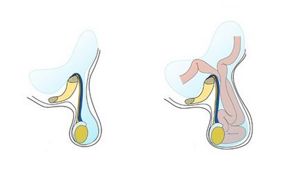 Tratamentul testiculelor cu picături și măsuri pentru prevenirea dezvoltării bolii