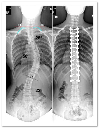 Bal oldali scoliosis az ágyéki, 1 fokozat, torna gyakorlatok