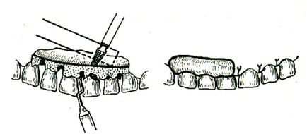 Chirurgie pe gingie înainte și după intervenția chirurgicală