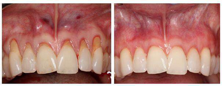 kezelés periodontális diabetes desmopressin for diabetes insipidus