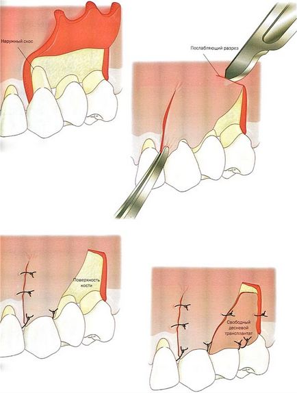 Operațiunea de operație pe gingie cu parodontită, centrul de stomatologie 