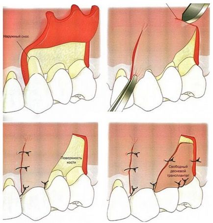 Operațiunea de operație pe gingie cu parodontită înainte și după